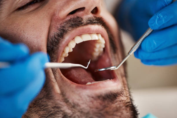 Best Emergency Dentist for Lost Fillings or Crowns in Bridgeport, IL